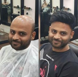 Hair fix service in bhubaneswar Get New Hair in just 2hrs Call 7008917701