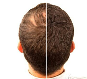 hair-fixing before after photo in hair fix solutions