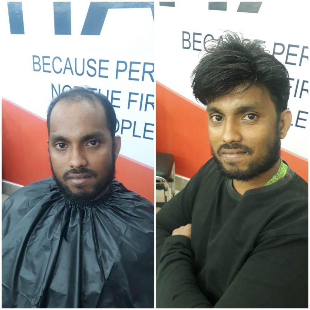 Hair Patch Work in Bhubaneswar